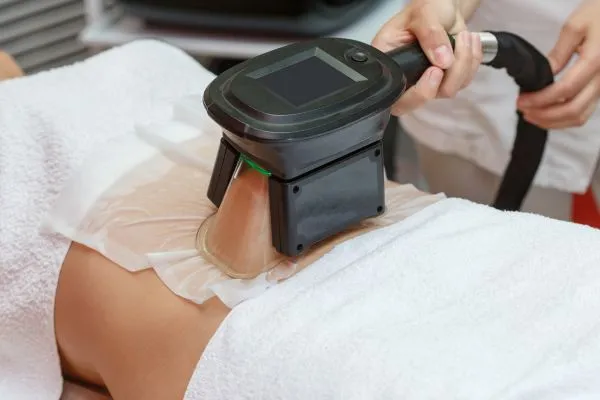 Image of person having fat freezing treatment to help weight gain Midlands