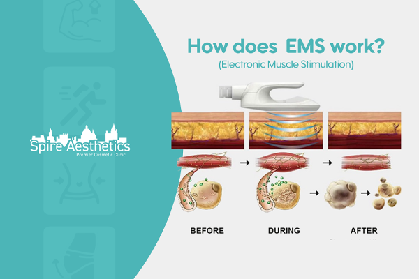 EMS treatment for post pregnancy weight loss treatment Midlands