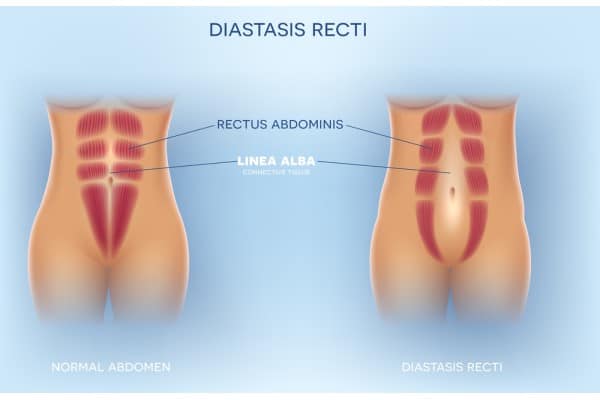 What Non-Surgical Options Are Available for Diastasis Recti Midlands ?
