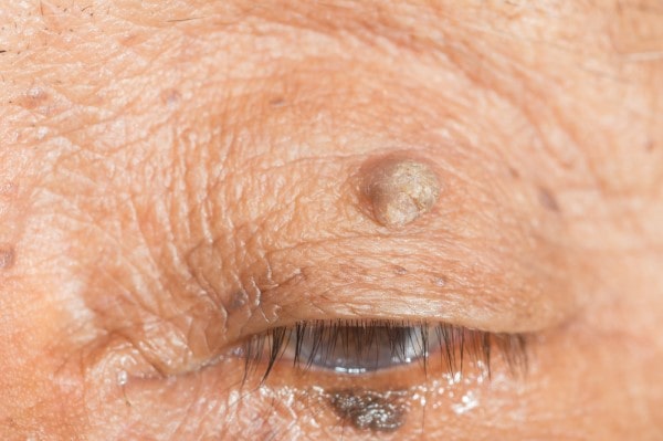 Skin imperfections Midlands  - Cryopen is fast and effective book in today!