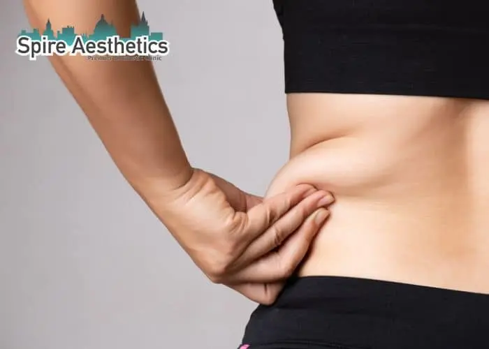 Image of woman pinching fat on their hips Midlands . Fat Freezing treatment