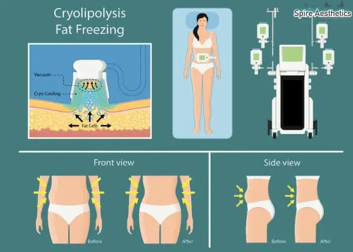 Fat freezing treatment Midlands benefits for competitions to remove stubborn fat deposits.