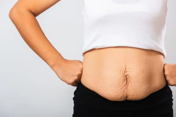 Image of a woman's stomach after weight loss with sagging skin following a gastric band Midlands