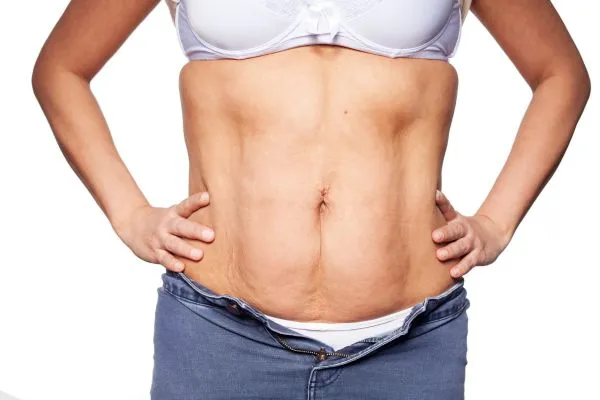 sagging skin on woman's stomach after weight loss injections Midlands