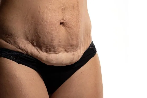 Image of womans stomach after weight loss injections Midlands showing saggy skin
