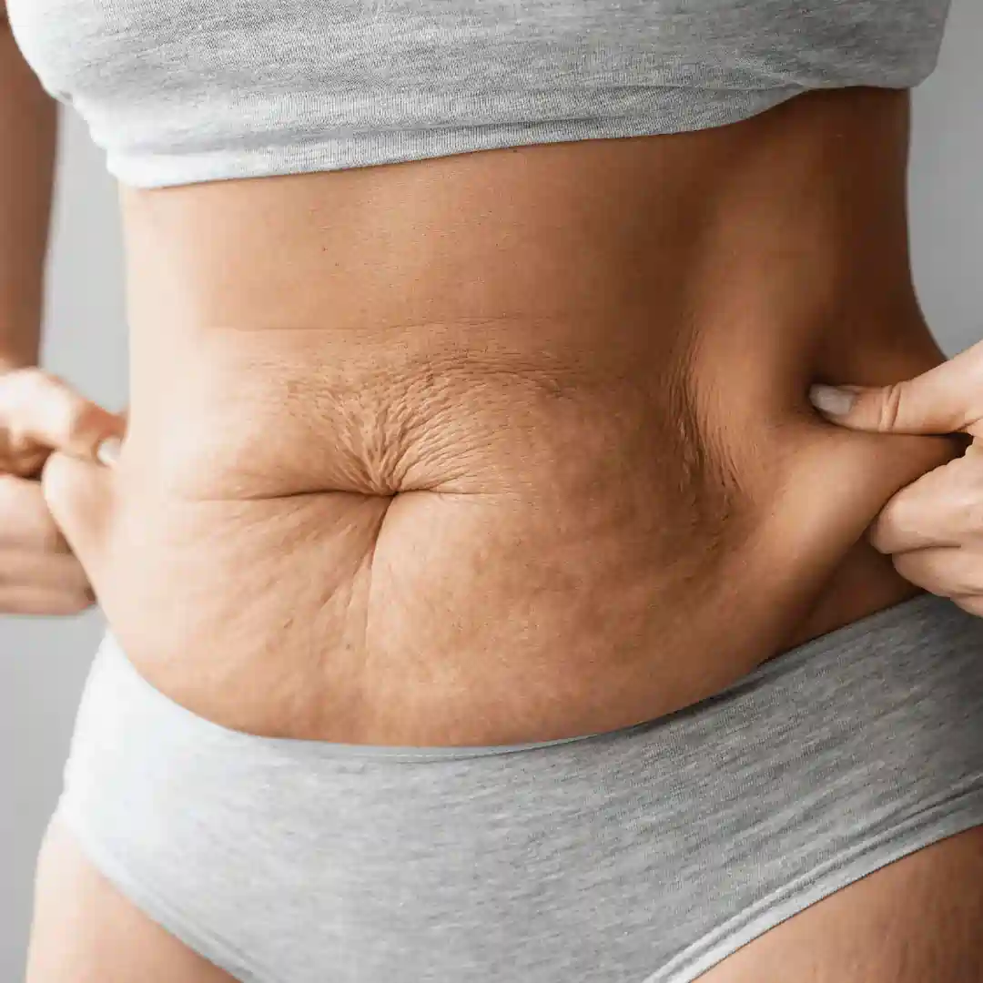 Is It Normal to Have Loose Skin After Pregnancy Midlands ?