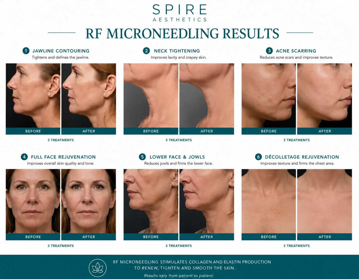 RF Microneedling Skin tightening Midlands results