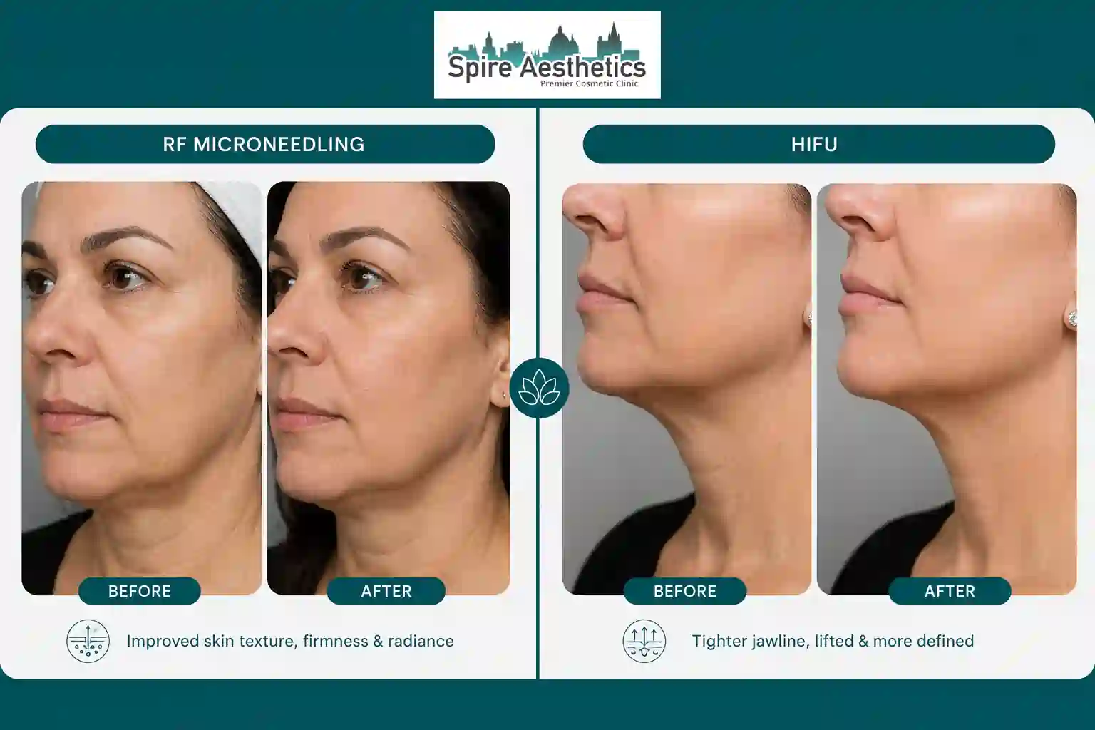 Can RF Microneedling and HIFU Be Combined Midlands ?