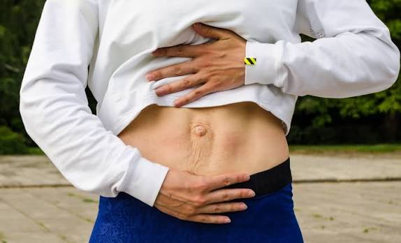 When Could Diastasis Recti Be the Missing Piece of the Puzzle Midlands ?