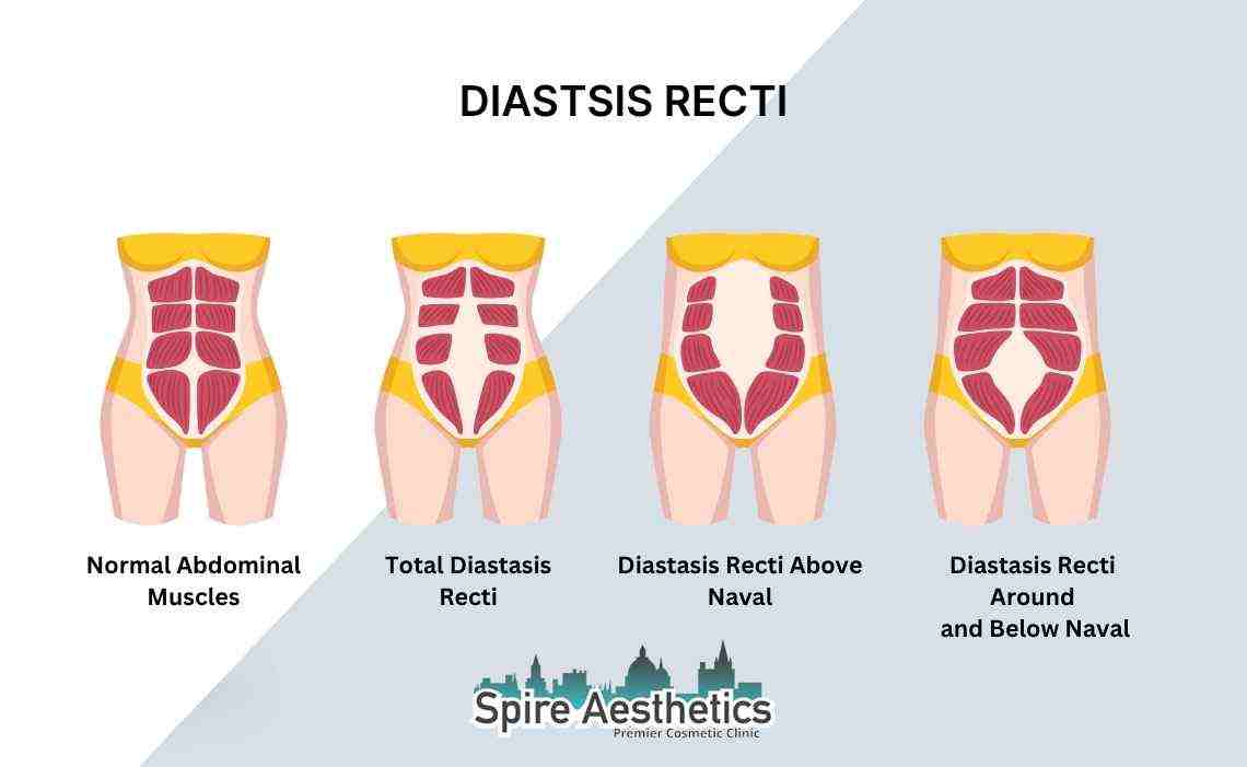 Is Non-Surgical Diastasis Recti Treatment Right for You? Common Concerns Answered Midlands